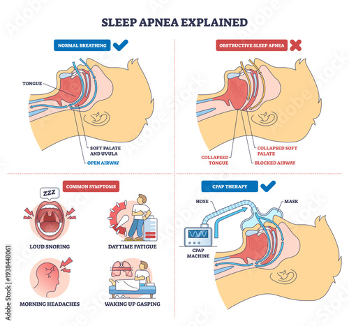 Sleep apnea explained, side-by-side airway cross-sections show normal, obstructed, and CPAP-treated breathing, key objects, airway, tongue, CPAP mask, transparent background.