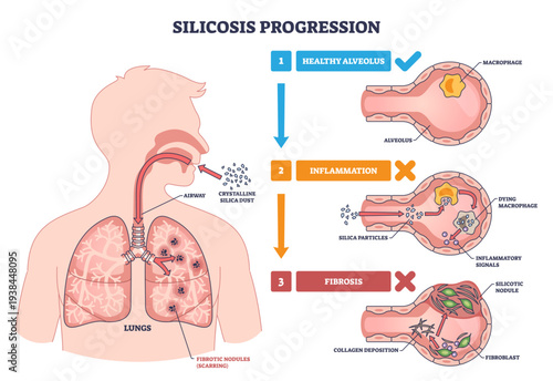 Silicosis progression shows how inhaled silica dust injures alveoli, triggering inflammation and lung fibrosis, key objects, lungs, alveolus, silica particles, transparent background.