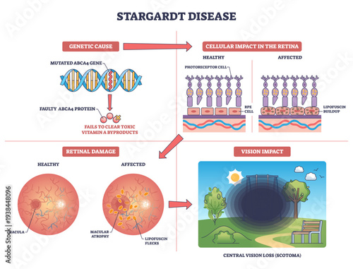 Stargardt disease overview linking ABCA4 mutation to retinal lipofuscin and central vision loss, key objects, ABCA4 gene, photoreceptor cells, macula, transparent background.
