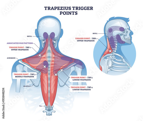 Trapezius trigger points diagram illustrates pain referral zones across neck, shoulders, and upper back, marking upper, middle, and lower fibers with X targets, transparent background.