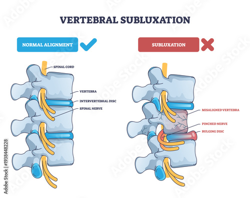 Vertebral subluxation diagram compares normal alignment with misaligned vertebra pinching nerve and bulging disc, key objects, vertebrae, discs, spinal nerves, transparent background.