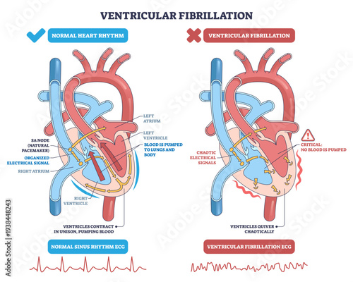 Ventricular fibrillation explained, side-by-side heart diagram contrasts normal rhythm with chaotic quivering, key elements are ventricles, electrical signals, and ECG traces, transparent background.