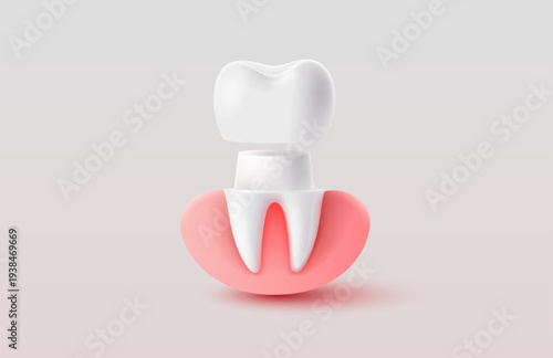 3D dental crown illustration with gum and tooth structure.