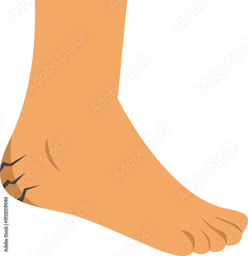 Detailed vector illustration of cracked heel showing dry skin foot care concept