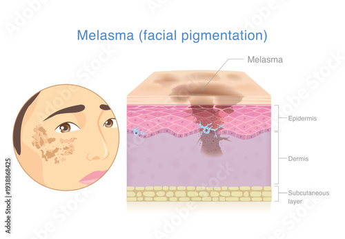 Melasma on woman's facial with anatomy of skin layer that show accumulation of pigment affect to dark spots and hyperpigmentation. Diagram for melasma treatment and skin uneven.