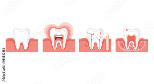 Educational diagram displays various stages of tooth health from a healthy white tooth to severe infection and decay.