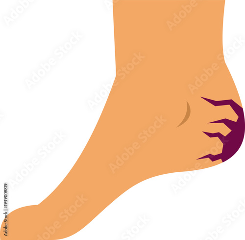 Illustration representing dry cracked heel symbolizing foot pain and skin damage