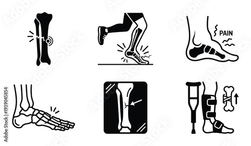 Stress Fracture Icon Set Vector: Bone Fracture, Pain, X-Ray, and Crutches Black and White Vector Illustration