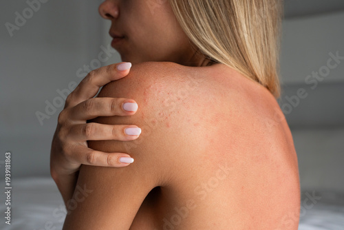 Young woman touching shoulder with small red bumps caused by sun allergy. Close-up of irritated skin on back after sun exposure, concept of UV reaction, sensitive skin and dermatology problem