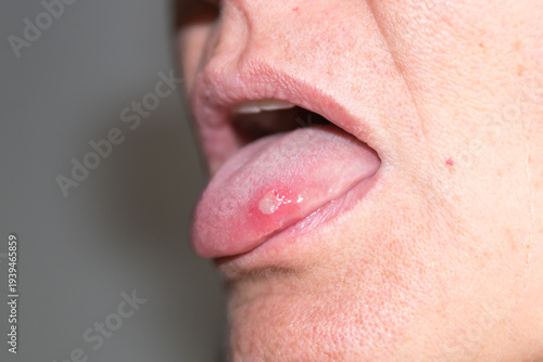 Painful tongue ulcer close-up showing canker sore in mouth