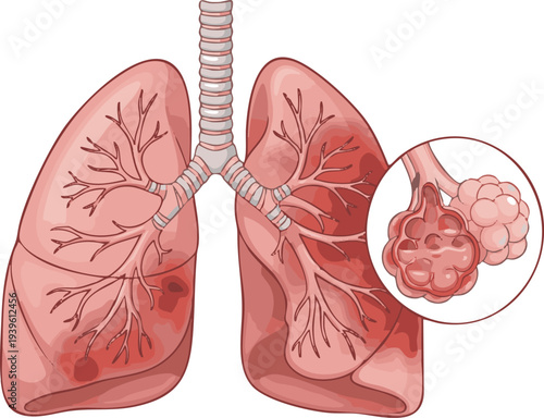Detailed vector illustration of the human respiratory system, highlighting the lungs, trachea, and bronchi, with an enlarged view of inflamed alveoli representing lung disease