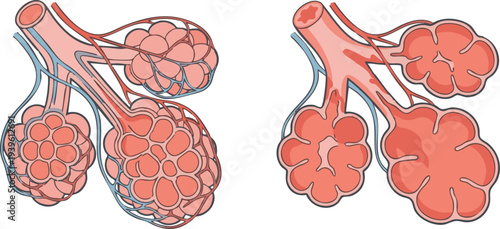 Clinical vector illustration depicting healthy lungs compared to lungs affected by emphysema, highlighting the difference in alveolar structure