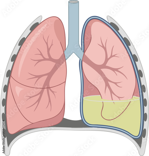 Illustration depicting the human lungs, showcasing their structure and a potential pleural effusion with yellow fluid accumulation