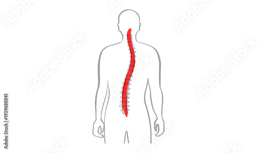 Scoliosis spine deformity