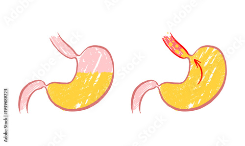 Gastroesophageal reflux pain