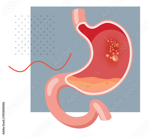 Stomach Tumour Growth - Gastric Cancer - Stock Illustration