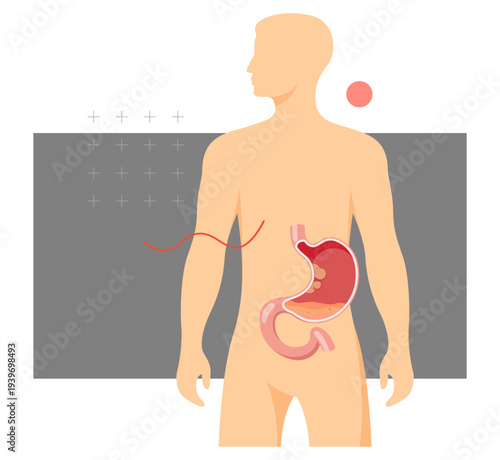 Stomach Tumour Growth - Gastric Cancer - Acidity Burn - Stock Illustration