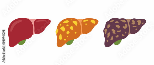 This educational illustration presents three liver patterns in vibrant colors, depicting liver health concerns and representing important health education and awareness.
