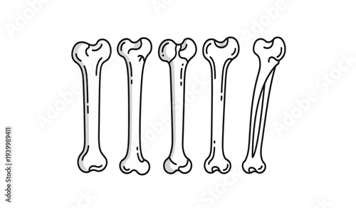 Illustration of human femur bones in various stages of healing