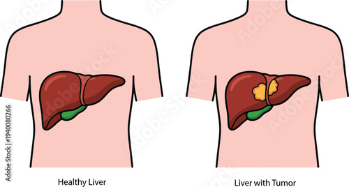 Medical illustration comparing healthy human liver and liver with tumor inside torso silhouette showing anatomy, disease concept, hepatology education, cancer diagnosis awareness graphic