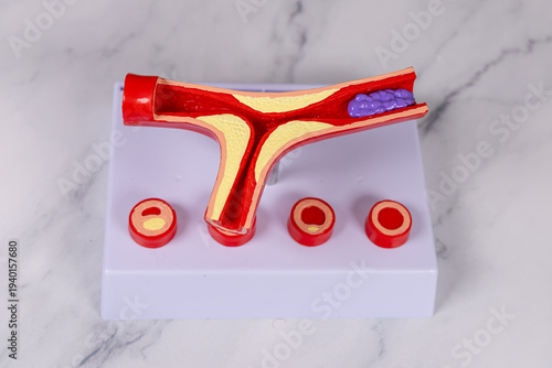 Cuadro en lienzo Gros plan sur le modèle 3D d'une artère bouchée par la graisse.