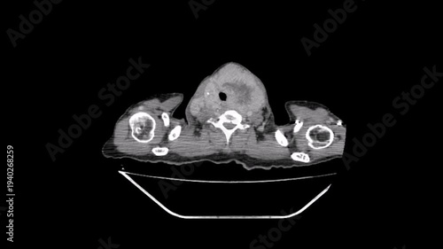 Chest CT scan  showing a mass in the upper chest indicating a cancer of the thyroid gland. And showing a secondary tumour in the right rib. And secondary tumour  in right and left lung 
