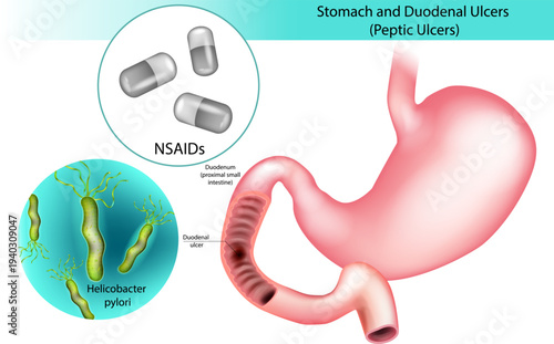 Peptic Ulcer Medical Illustration Showing Duodenum and Helicobacter pylori Infection. Duodenal Ulcer Diagram with NSAIDs and Helicobacter pylori Causes