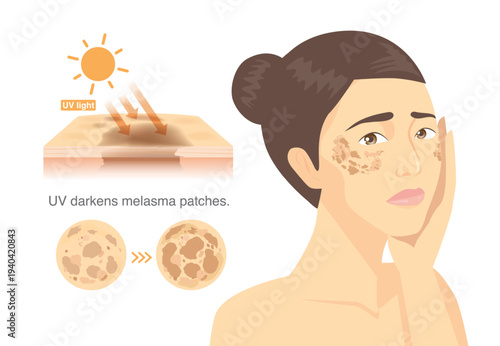 Woman touch her face with melasma on side cheek. UV light is the factor that causes melasma on skin surface. Melasma darken after exposure to sunlight.