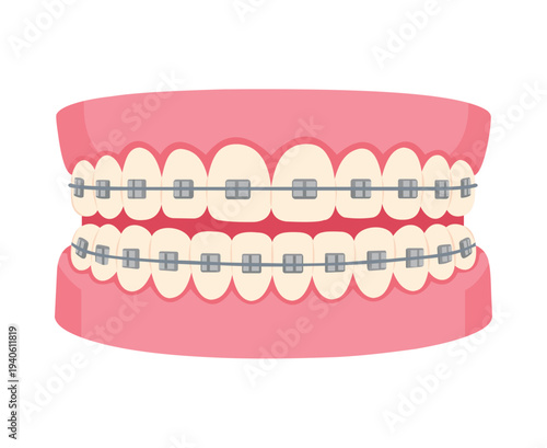 Dental Teeth Model With Metal Braces On White Background