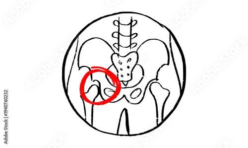 Osteomyelitis disease sketch