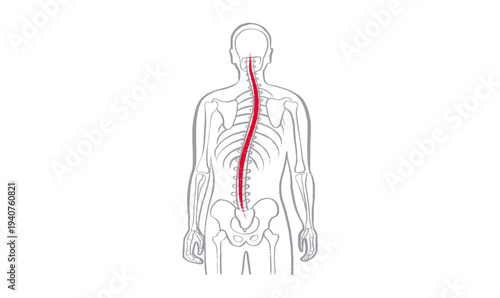 Scoliosis spine deformity