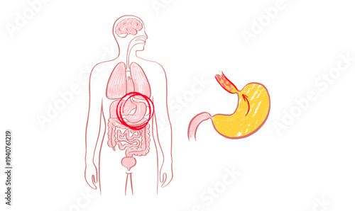 Gastroesophageal reflux pain