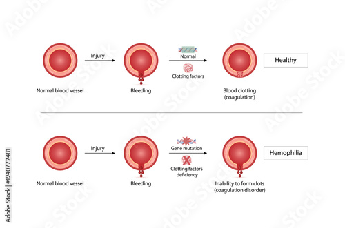 Hemophilia, a bleeding disorder that slows the blood clotting. Haemophilia (Coagulation disorder). Damaged blood vessel, hemorrhage. Healthy blood vessel after bleeding. Vector illustration. 