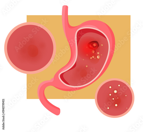 Inflamation of Stomach Lining and Gastric Ulcers - Stock Illustration