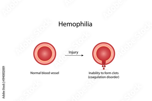 Hemophilia, a bleeding disorder that slows the blood clotting. Haemophilia (Coagulation disorder). Damaged blood vessel, hemorrhage. Healthy blood vessel after bleeding. Vector illustration..