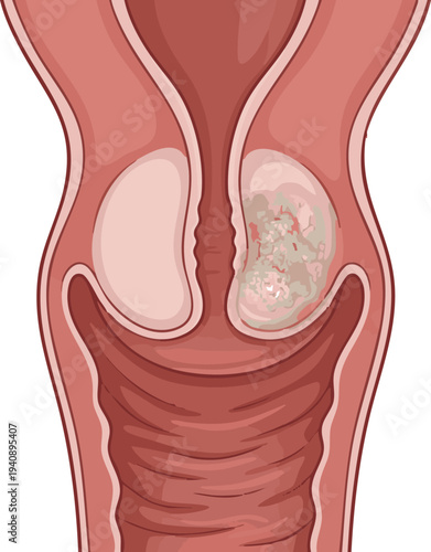 Illustration depicting a cancerous growth within the cervix, highlighting a medical concern for women's health and potential gynecological issues