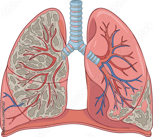 Illustration of Lungs with Signs of Disease, Showing Inflammation and Abnormal Tissue Growth