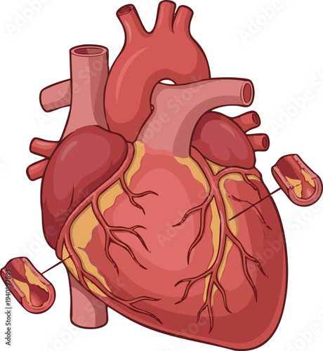 Detailed vector illustration of a human heart showing arterial plaque and cardiovascular disease, highlighting health risks and anatomical concerns