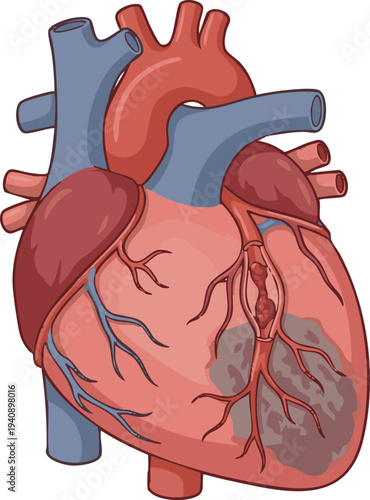 Detailed vector illustration of a human heart depicting a coronary artery blockage and myocardial damage, representing cardiovascular health issues and medical conditions