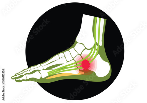 Foot pain illustration. Plantar fasciitis diagram. Medical graphic. Human anatomy.