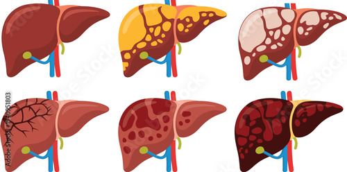 Liver disease progression stages illustration, healthy liver to cirrhosis medical anatomy diagram, hepatology healthcare vector educational set