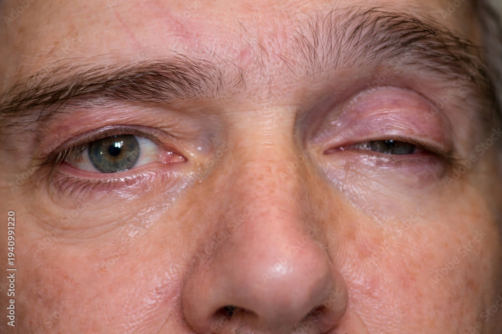 Fototapeta premium A close‑up of the eyes showing one swollen, partially closed eyelid with surrounding redness, highlighting ocular swelling, eyelid changes, and clinical evaluation of eye conditions.