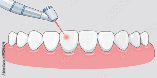 Laser Dentistry: Precision dental laser targeting a tooth, symbolizing advanced dental care and treatments. 