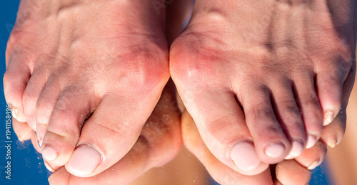 фотографія Hallux valgus deformity of big toe joint