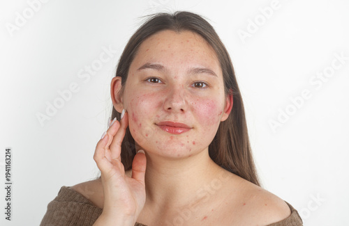 Pimple on face. Skin acne texture. Close up pimple skin. Problem skin with pimple. Pimples, acne, pores, scars on face. Pimple treatment. Pimples on face.