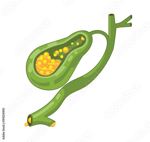 Gallbladder Anatomy with Gallstones Medical Illustration