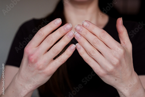 Female hands with weak natural nails and damaged manicure