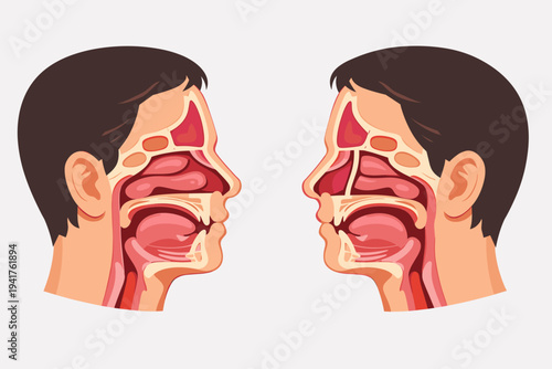 Vector Illustration of a Human Head Cross Section Comparing a Normal Nasal Septum with a Deviated Nasal Septum, Showing Sinuses, Nasal Cavity, and Respiratory Anatomy for Medical Education.