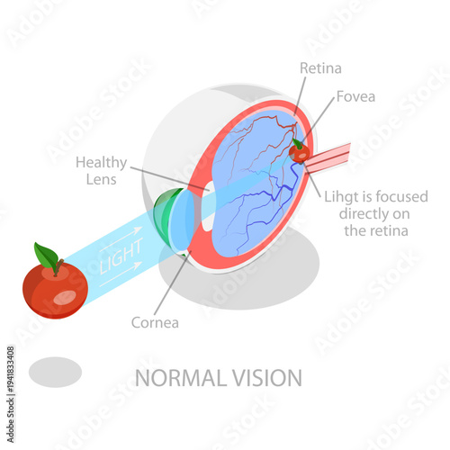 3D Isometric Flat Vector Illustration of Vision Disorder, Far-Sightedness And Near-Sightedness Anatomical Diagram. Item 3