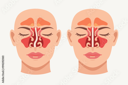 Vector Illustration of Human Face Cross-Section Comparing a Deviated Nasal Septum with a Normal Straight Septum, Showing Sinuses and Nasal Cavity Anatomy for Medical and Healthcare Education